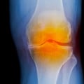 A Comprehensive Guide to Knee Replacement at EBOO Clinic