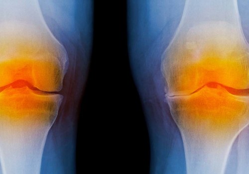 A Comprehensive Guide to Knee Replacement at EBOO Clinic