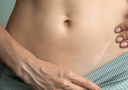 All You Need to Know About Appendectomy